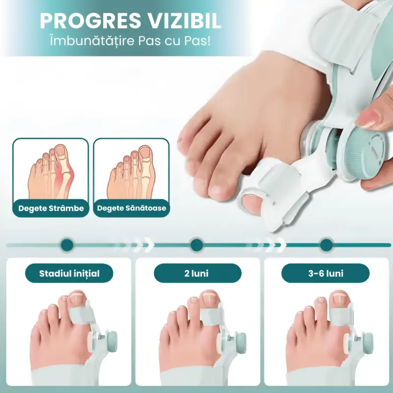Corector Hallux Valgus Reglabil cu 3 Unghiuri De Corectie
